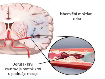 Sơ lược về bệnh tai biến mạch máu não